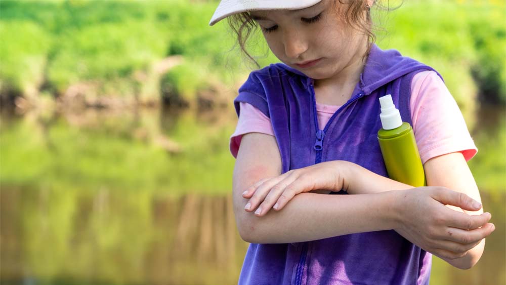 Managing and Preventing Mosquito Bites in Children
