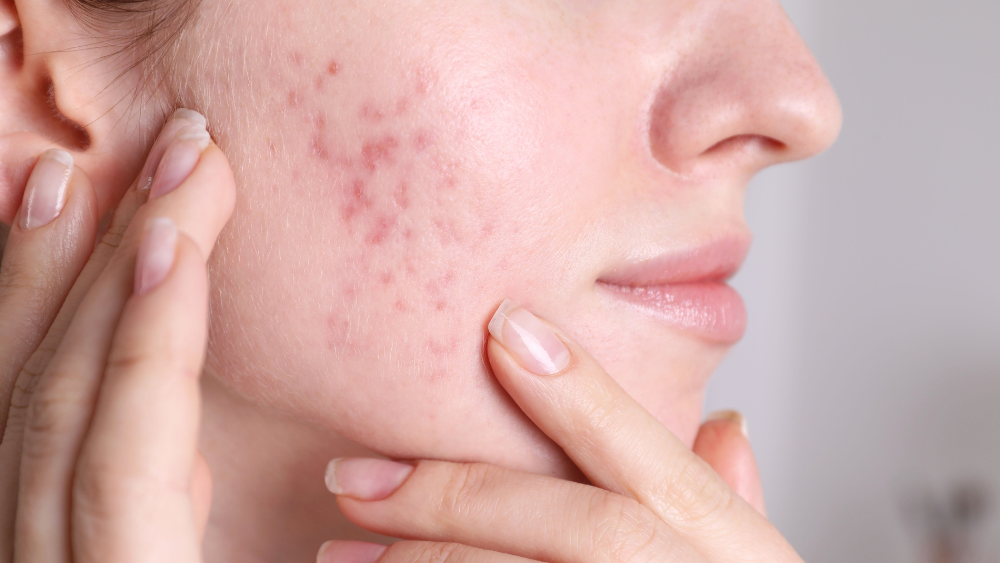 Say Goodbye to Acne Marks: How to Prevent and Treat Redness, Dark Spots, and Scarrin