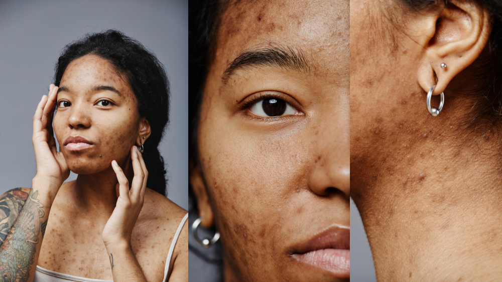 Effective Treatments for a Brighter, More Even Complexion