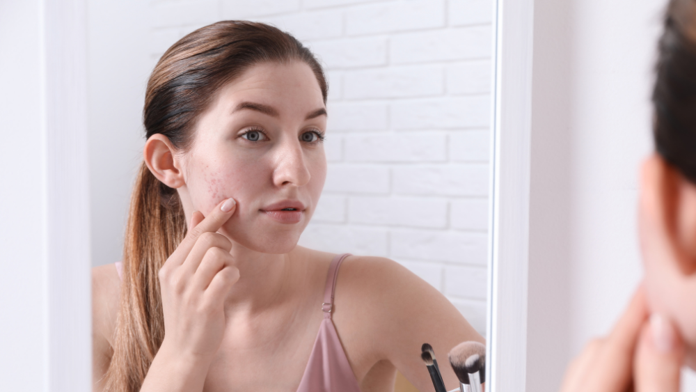 What Really Causes Acne Scarring? Struggling to Leave Breakouts Behind?