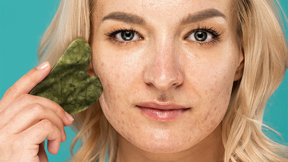 What causes acne scarring?