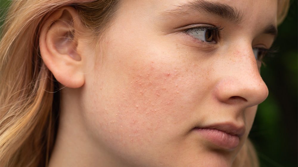 Comprehensive Guide to Understanding and Managing Rosacea