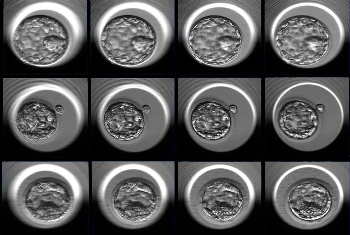 Invitro fertilisation – a miracle under a microscope